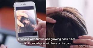 Activities including going for a walk, finding time to read, listening to favorite music, and more. What Is Alopecia Definition Symptoms Treatment Nioxin
