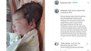 Pada dasarnya, perawatan dilakukan tergantung pada kondisi anak dan penyebab yang mendasarinya. Viral Video Kepala Bayi Jadi Lonjong Karena Ditarik Alat Vakum Dokter Berikan Penjelasan Tribunnews Com Mobile