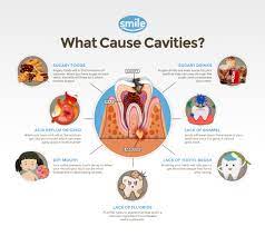 Pediatric Dentistry | What Are The Causes Of Cavities