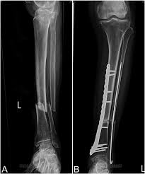How does a tibia/fibula fracture happen? A The Radiograph Of Left Tibia And Fibula Shaft Open Fracture Type Download Scientific Diagram