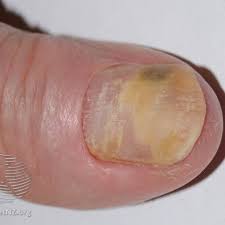 Image result for Onycholysis feet