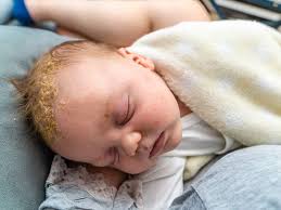 Image result for white scabs on the head in children