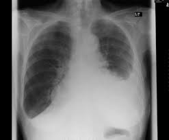 Pleural effusion that is confined to one or more fixed pockets in the pleural space. Pleural Effusion Concise Medical Knowledge
