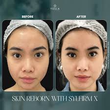 With Tosca Skin Reborn, utilizing Sylfirm X technology of RF microneedling,  acne scars and skin barriers are repairable. Wanna see your transformation  too? 🌟 Contact us now! #ToscaClinic Be the best version