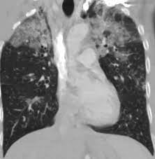 En cas de doute, on pourra réaliser une biopsie pulmonaire (au cours d'une chirurgie ou lors d'une fibroscopie bronchique), souligne le dr maxime patout. Http Onclepaul Net Wp Content Uploads 2011 07 P Infiltrantes Infectieuses Hrm 2012 Fileminimizer1 Pdf