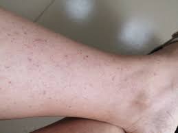 小腿皮下红点和瘀青日益严重