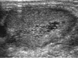 It typically occurs in those with a prior vasectomy but can be also seen with other causes of obstruction of the ductus deferens. Tubular Ectasia Of Rete Testis Pacs Entwicklung