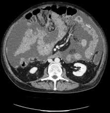 We did not find results for: Peritoneal Carcinosis With Massive Ascites Download Scientific Diagram