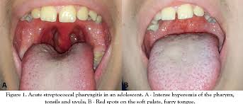Image result for Pharyngitis