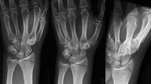 Deformarea membrelor în fracturi este vizibilă îndacă resturile sunt deplasate. Fractura LiniarÄƒ A Procesului Stiloid Radial Anatomie Proces Stiloid Radial Trebuie SÄƒ Chem O AmbulanÈ›Äƒ