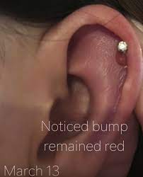 Piercing Bump 6 Ways To Get Rid Of Cartilage Or Nose Keloid Blister
