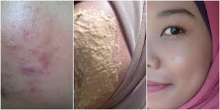 Kemudian kisar kesemuanya sehingga halus dan campurkan dengan sedikit air. Petua Hilangkan Parut Jerawat Dalam Masa 7 Hari Petua Ibu