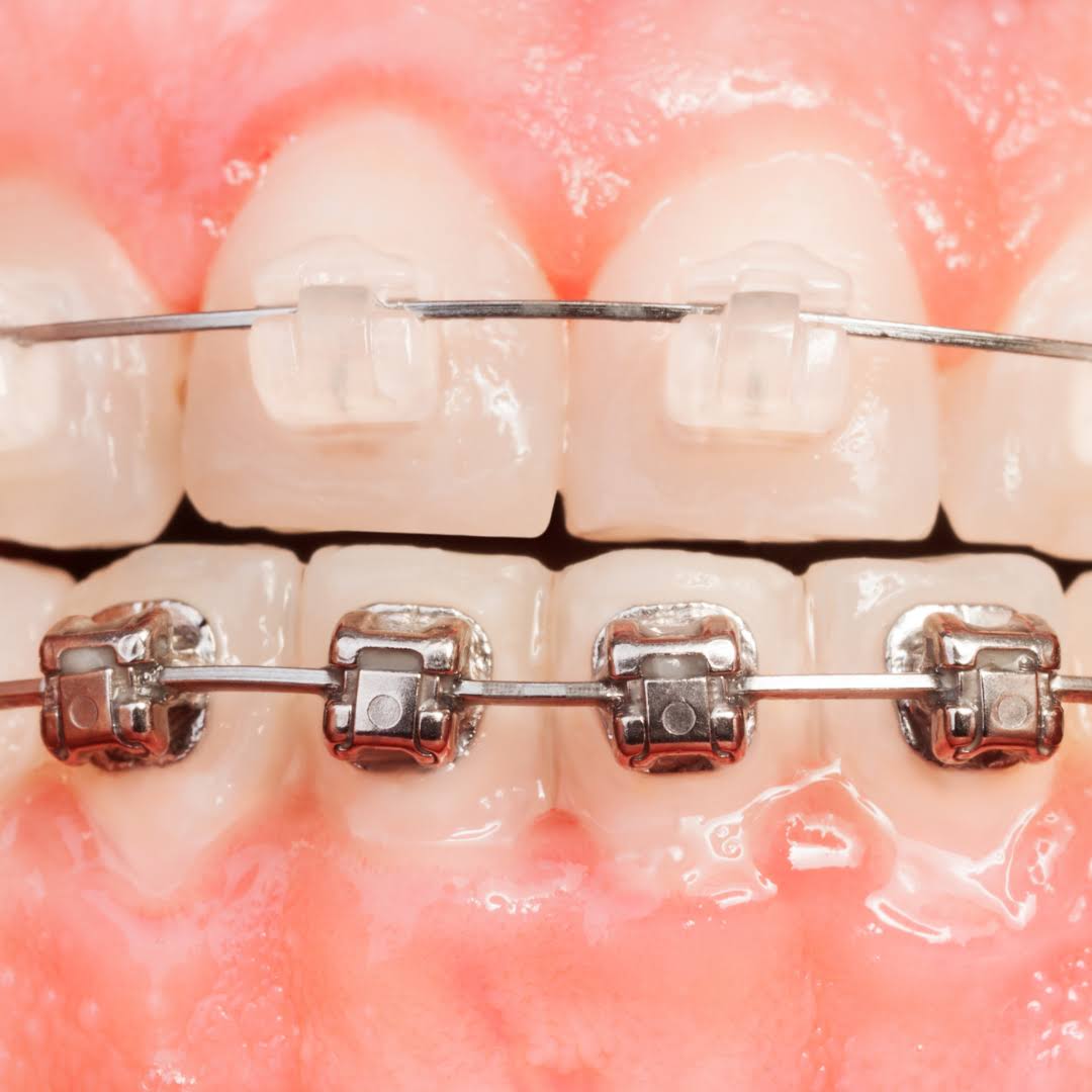 Braces product image