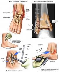 Cirugia De Reduccion Abierta Y Fijacion Interna Western New York Urology Associates Llc