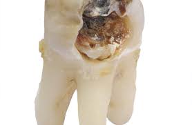 One of the most effective ways to cure a tooth infection is to rinse your mouth with a solution of salt water. Rotting Teeth And What To Do For Adults And Children Alike Evolve Dentistry Dentist In Portishead Somerset