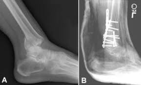 When an ankle is fractured, the malleoli are broken. Ankle Fractures Broken Ankle Orthoinfo Aaos
