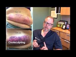 Pin On Colon Cleanse Weight Loss