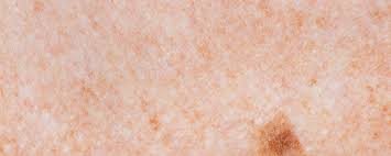 It affects people of all races, genders and ages, which is why it's absolutely critical for americans to learn about. Melanoma And Age Spots Age Spots Maryland The Vein Center