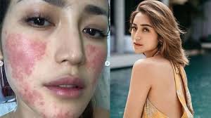 Maybe you would like to learn more about one of these? Saat Wajahnya Ruam Jessica Iskandar Stres Takut Enggak Bisa Kerja Tribunnews Com Mobile