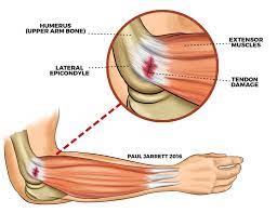 What is lateral and medial epicondylitis? Mr Paul Jarrett Epicondylitis Tennis Elbow Golfer S Elbow Murdoch Orthopaedic Clinic