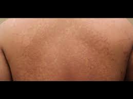 فطريات الجلد youtube