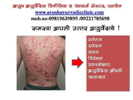 psoriasis treatment 10 % off product image