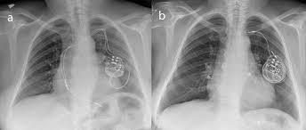Pacemakers and implantable cardioverter defibrillators dr. Https Www Ejradiology Com Article S0720 048x 14 00580 4 Pdf