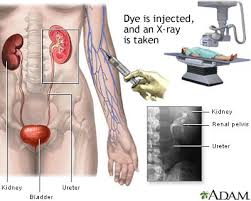 Ivp Pyelogram Npo After Midnight If Contrast Used Ask For Allergy Of Iodine Or Shellfish Intravenous Kidney Kidney Stones