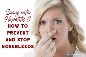 The resulting damage to small blood vessels in the nose induces bleeding. Prevent Stop Nosebleeds Hepatitis C Hepatitis Central