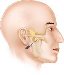 Image result for Ear Nerve Block