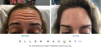 If you are being treated for upper limb spasticity, your first dose of dysport can be up to 1000 units in total depending on the size if you are being treated for lateral canthal lines, the recommended dose of dysport is 30 units per side to be divided equally among 3 injection sites (60. Botox Dysport Drellenmahony Com