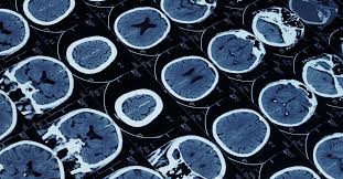 We specialize in the areas of epilepsy, spine and brain disorders, parkinson's disease, alzheimer's disease, sleep disorders, stroke, dementia and overall nervous system care. Ms Multiple Sclerosis German Neuroscience Center Dubai