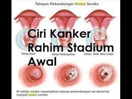 Tanda kanker serviks lainnya dapat dilihat dari kondisi organ wanita yang mengalami sakit pada pelvis, mengalami pendarahan apabila sudah dilakukan pemeriksaan pelvis, mengalami pendarahan. Gejala Kanker Serviks Gerakan Peduli Kanker Serviks Facebook