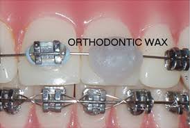Patients with braces face a number of challenges during treatment. What Is Orthodontic Wax News Dentagama