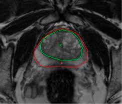 Mri can not only confirm the presence of prostate cancer but pinpoint its location. Computer Aided Detection Of Prostate Cancer With Mri Academic Radiology