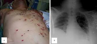 Shooting guns at meat (or how. Ballistics Chapter 10 Color Atlas Of Emergency Trauma