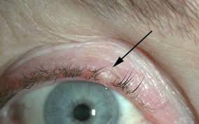 What patients and caregivers need to know about. What Are The Most Common Sites For Basal Cell Carcinoma