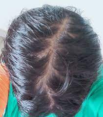 Hair coming out in unusually large clumps in (or out of) the shower is typically not a good traumatic events or extreme stress can cause sudden hair loss, which is usually temporary. I Hv Been Going Through Extreme Hair Loss Since So Many Days Whenever I Would Applied Any Oil The Hair Fall Become More Intense Than Before Please Suggest A Good Shampoo And