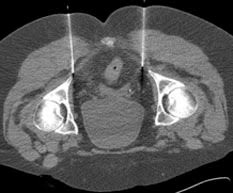 Image result for Pudendal Block