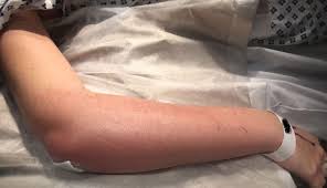 It is not exactly communicable nor contagious. Successful Management Of A 24 Year Old Pregnant Woman With Necrotising Fasciitis Of The Forearm Bmj Case Reports