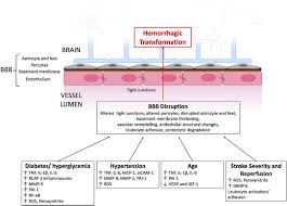 Image result for Stroke Pathophysiology