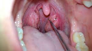 Batuk merupakan respon tubuh untuk mengeluarkan lendir, debu atau jerebu melalui saluran pernapasan. Betul Ke Makan Aiskrim Vanilla Boleh Sembuhkan Sakit Tonsil Ini Jawapan Doktor