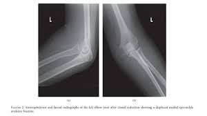 Because it is the site of origin of the flexor/pronator mass and the elbow lateral collateral ligaments, avulsion fractures are particularly. Health Reference Center Academic Document Intra Articular Entrapment Of The Medial Epicondyle Following A Traumatic Fracture Dislocation Of The Elbow In An Adult