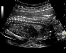 Cpam to icpam migration checklist. Echogenic Fetal Lung Lesion Sequestration Vs Cpam Type Iii Radiology Case Radiopaedia Org