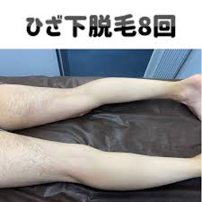 ひざ 下 脱毛 何 回 で 完了