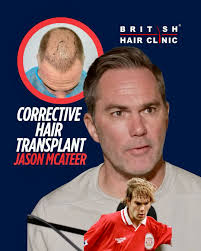 CORRECTIVE HAIR TRANSPLANT ✓ @trigs4