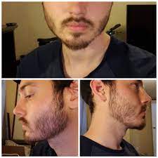 Slow hair growth is becoming more common for both men and women due to poor diets and stressful lifestyles. I M Losing Confidence A Little Over 1 Month I M 28 This Seems A Bit Too Patchy I Realize I Grow Facial Hair Slow But I Wish It Were More Evenly Spread Debating