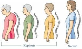 Posture Brace Guide Straight Up Reviews On Posture Corrector Products