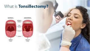 Image result for Tonsillectomy