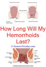 Pin On Hemorrhoid Relief